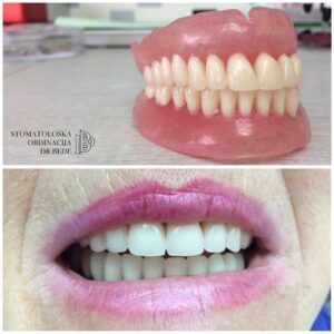 types of dentures
